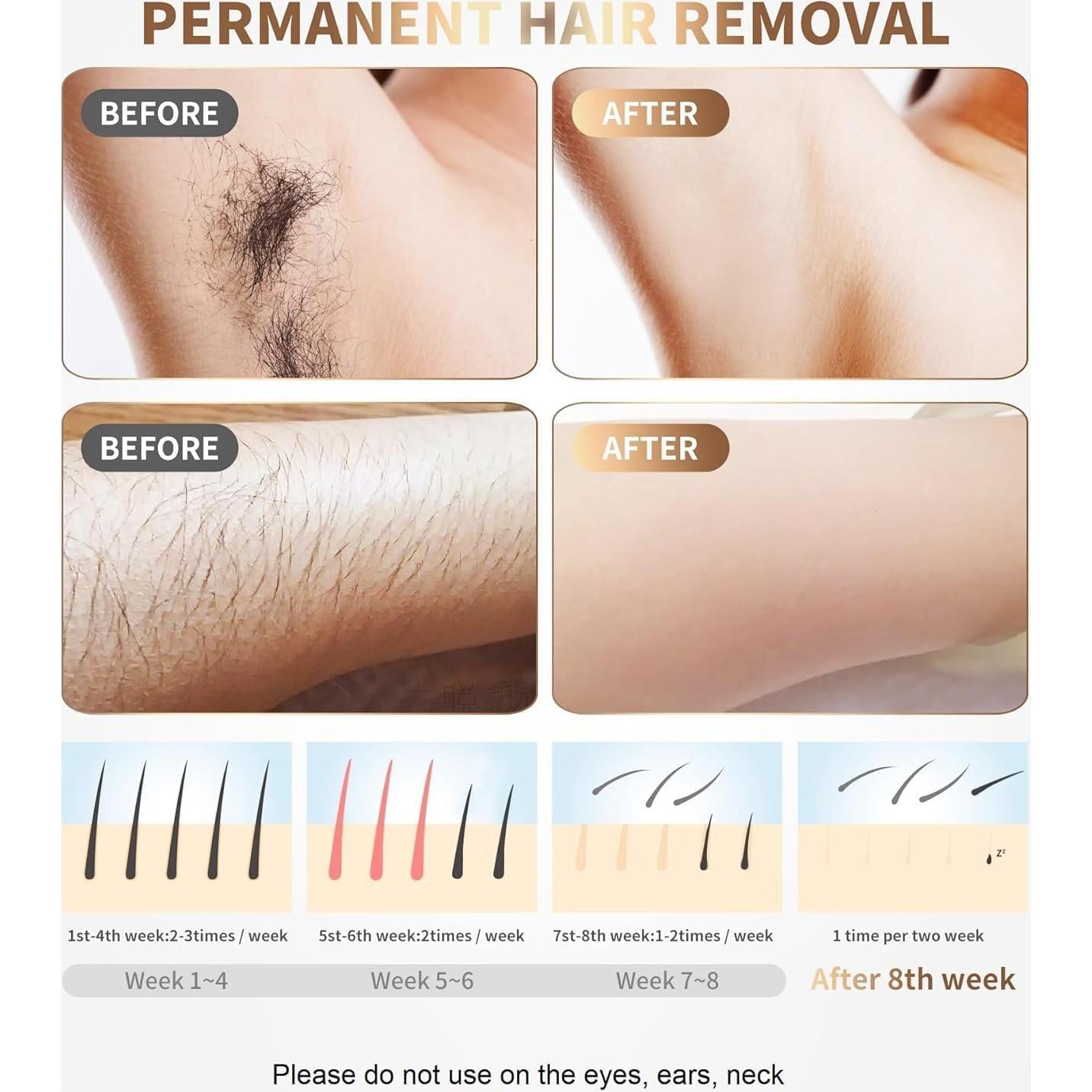 Depiladora Láser IPL Gransumr 999,999 Destellos Indolora