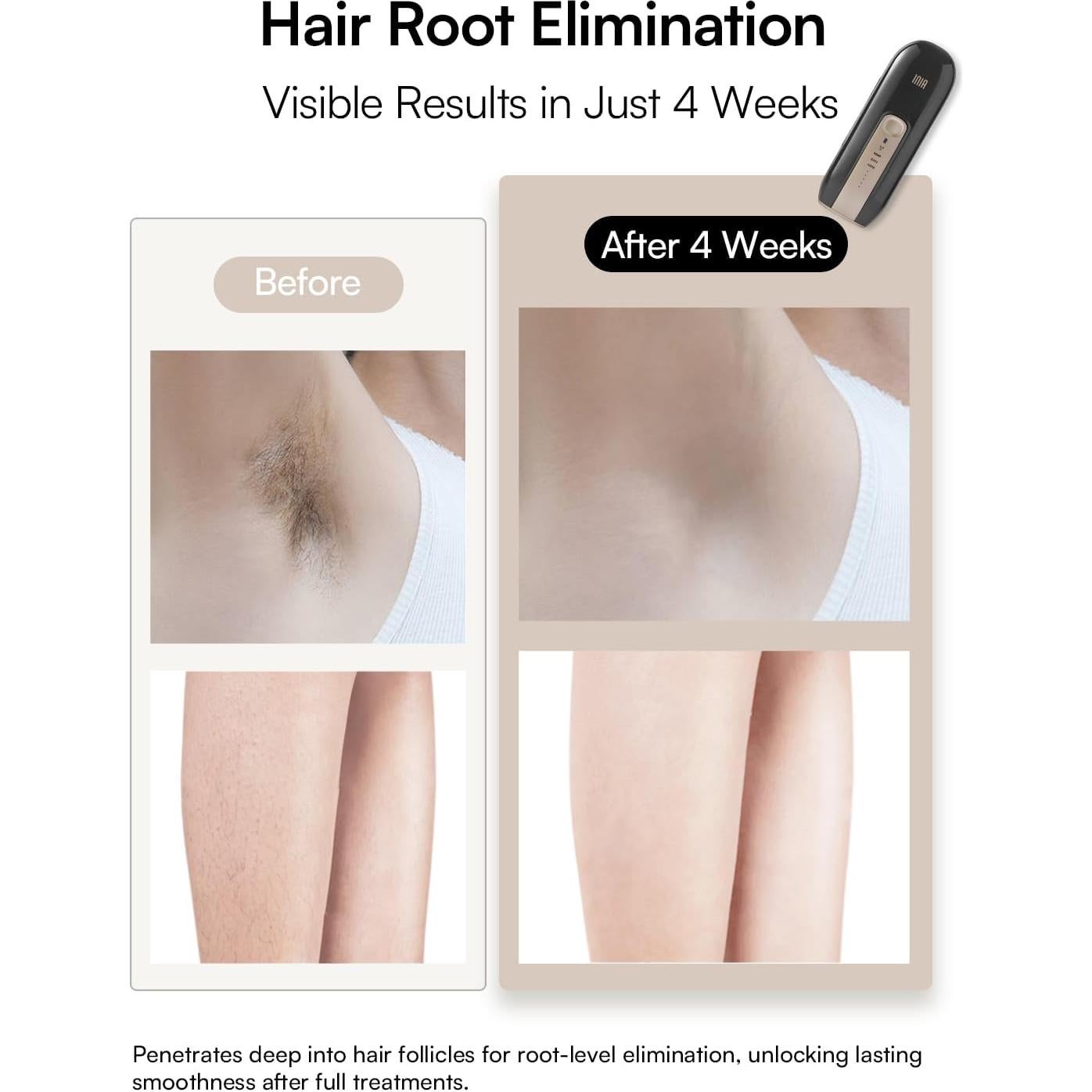 Depilador Láser INIA Fond para Cuerpo y Cara, 5 Niveles