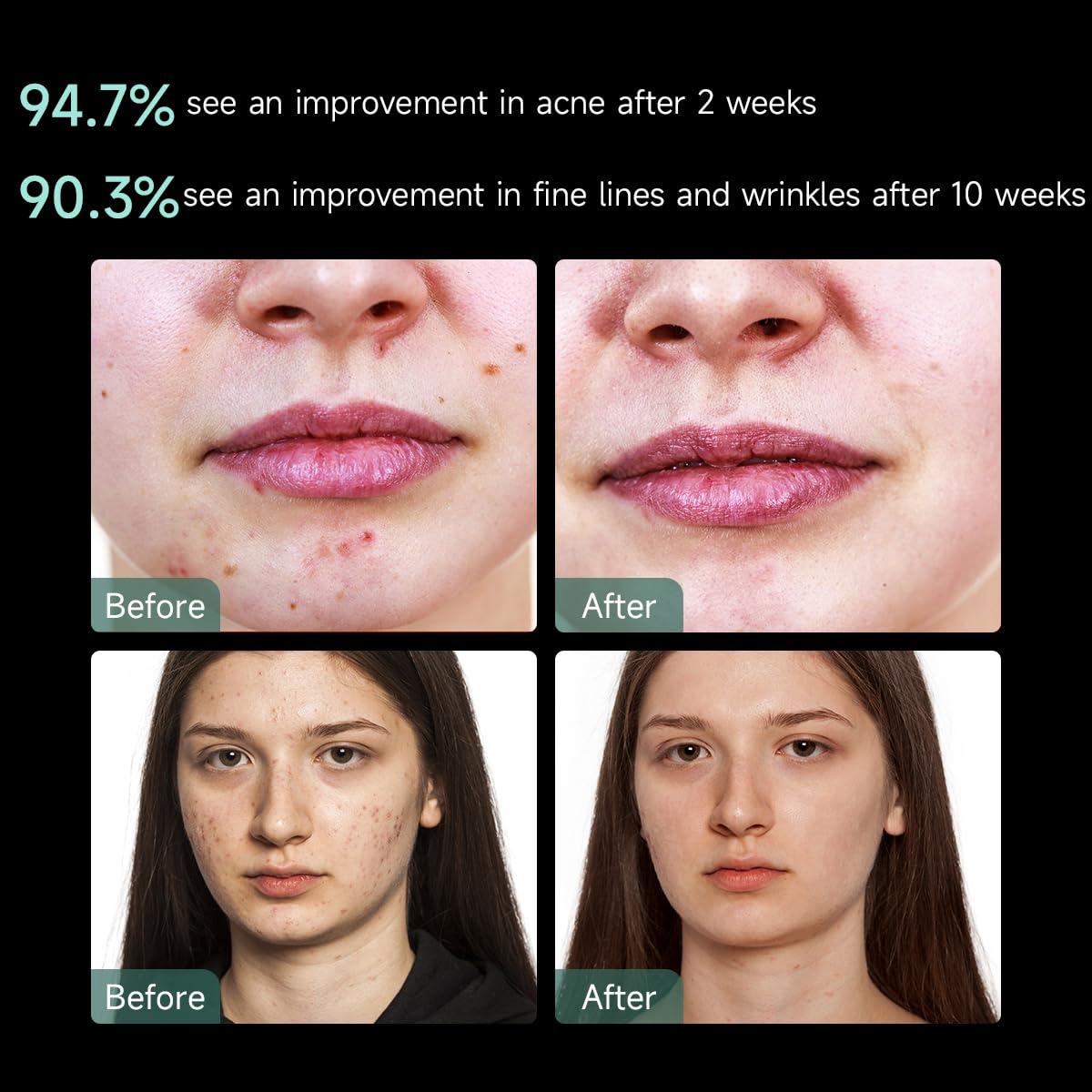 Máscara Facial LED Aphrona | Terapia Luz Roja y Azul