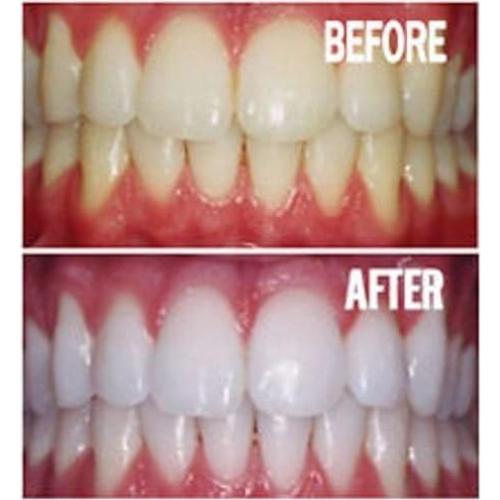 Kit Blanqueador Dental Dentech - 10 Tubos 44% Peróxido