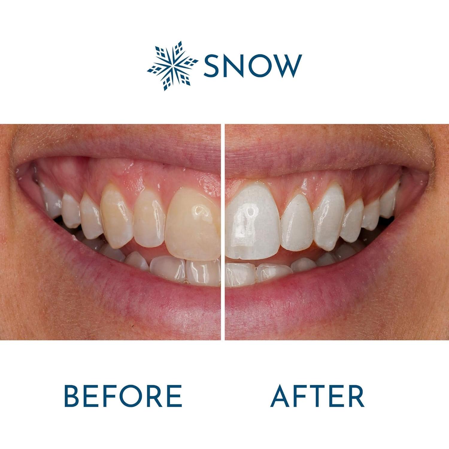 Snow Extra-Strength Teeth Whitening Serum - Oral Care Teeth Whitener Pen - Whitening Pen for Stain Removal & Whiter Teeth - Tooth Whitener with Potassium Nitrate and Hydroxyapatite - 1 Pack