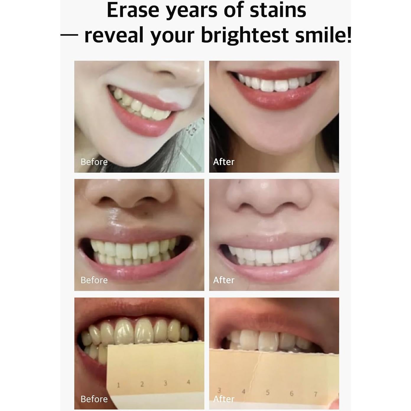 Kit Blanqueamiento Dental Live Orals PureDia - Gel y Boquilla