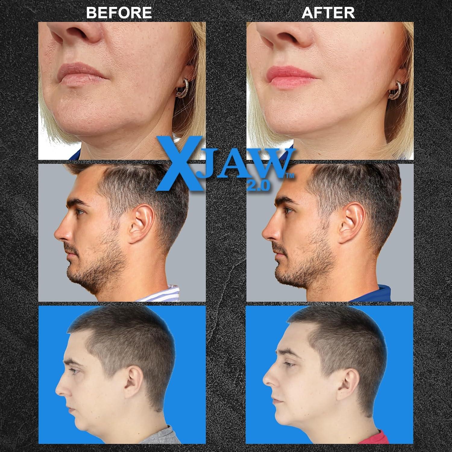 X-JAW 2.0 Ejercitador de Mandíbula Premium, 4 Niveles