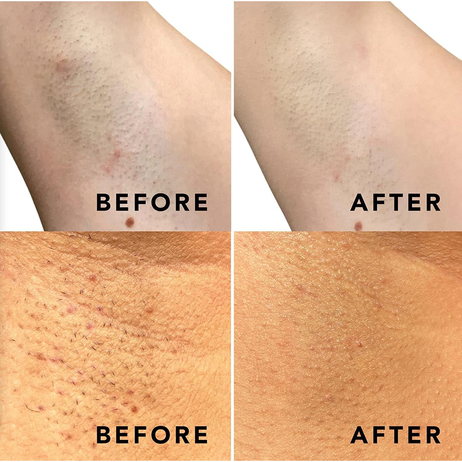 SweetSpot Labs Almohadillas Exfoliantes 2 Pack para Vellos Encarnados