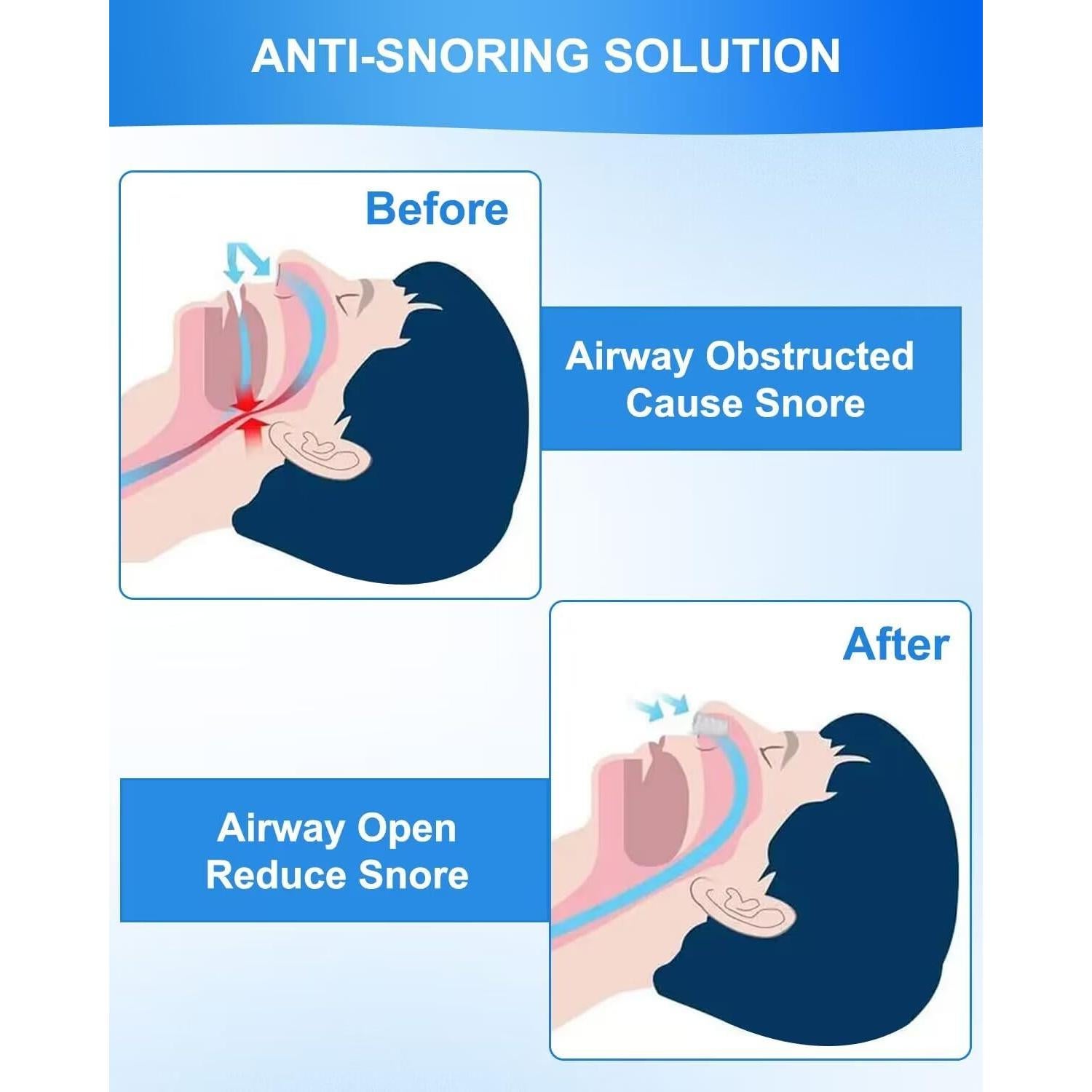 Dilatadores Nasales MQFORU 4 Tamaños Silicona Antirronquido