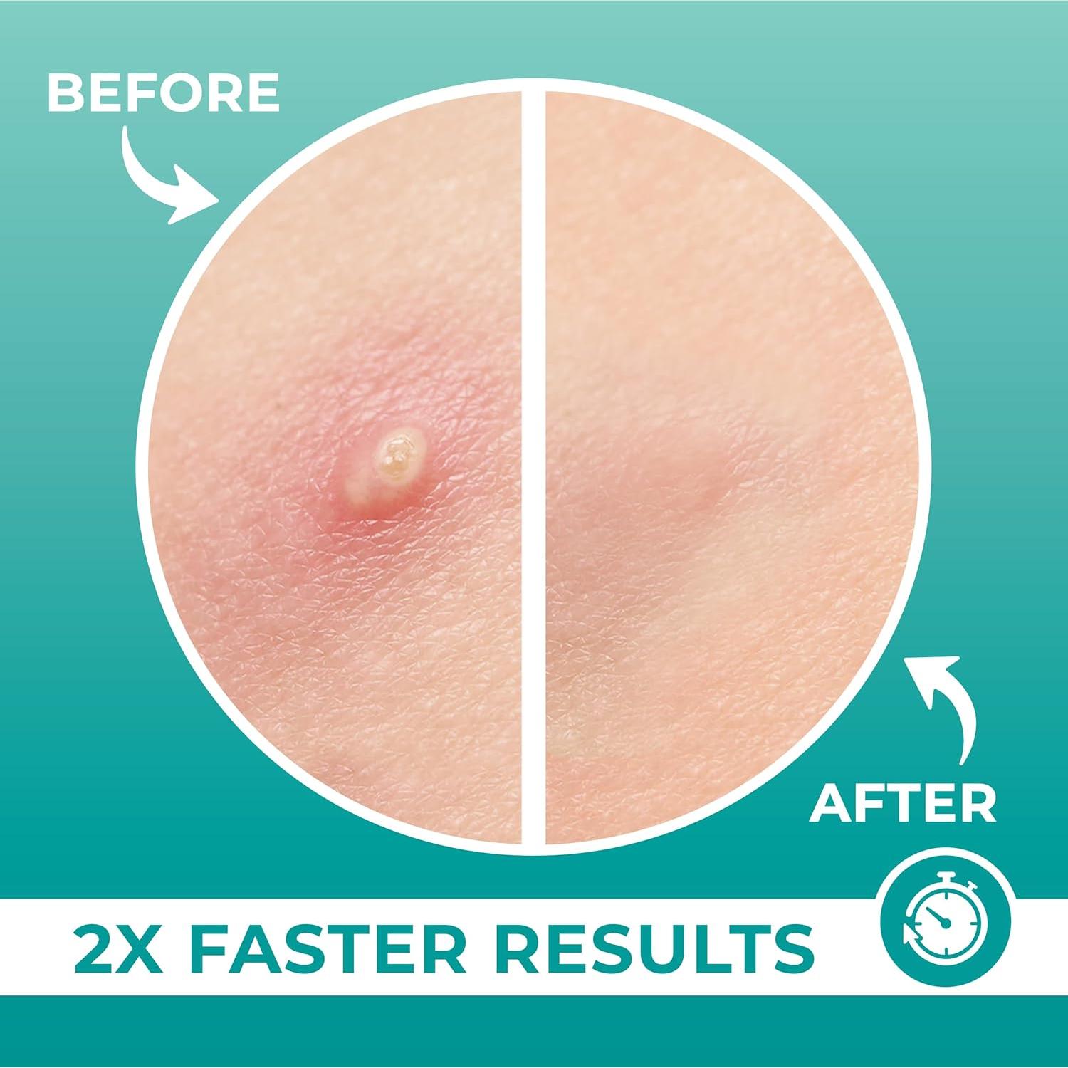 Parches para Granos PatchRx Nariz 12 Piezas Hidrocoloide