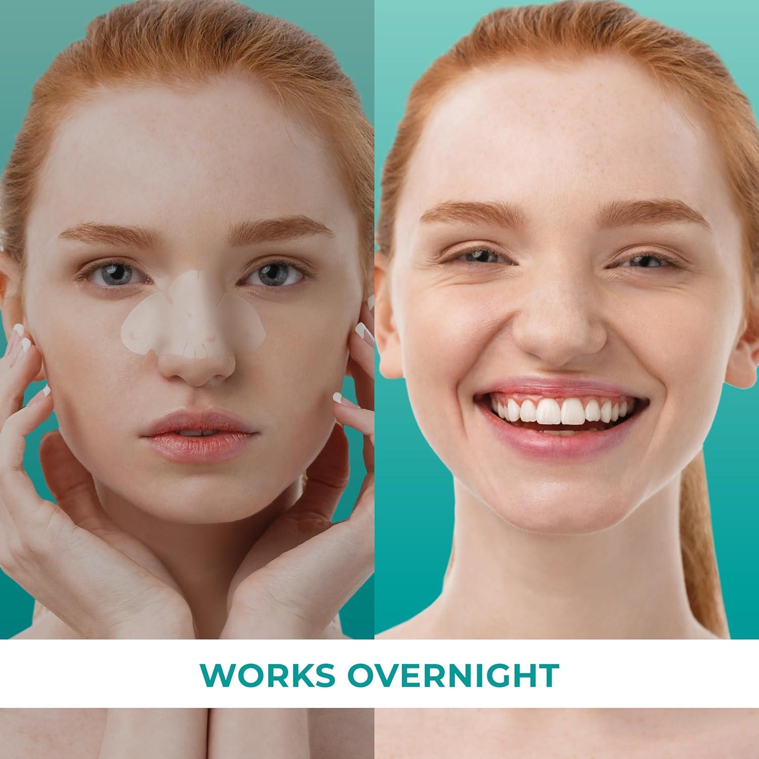 Parches para Granos PatchRx Nariz 12 Piezas Hidrocoloide