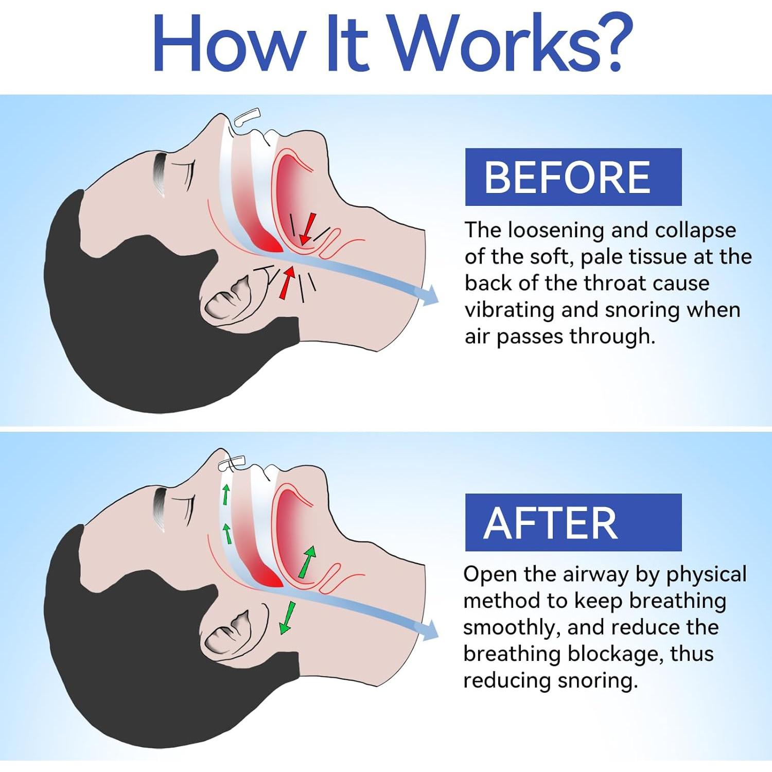Clip Nasal Anti Ronquidos Anngola - 10 Paquetes Efectivos