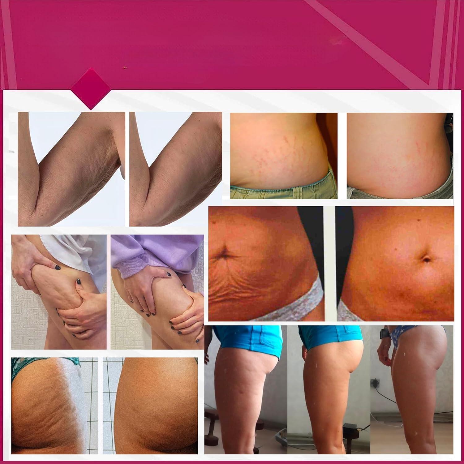 Crema Gel Anticelulitis Anacis 144g - Reducción y Tono Piel