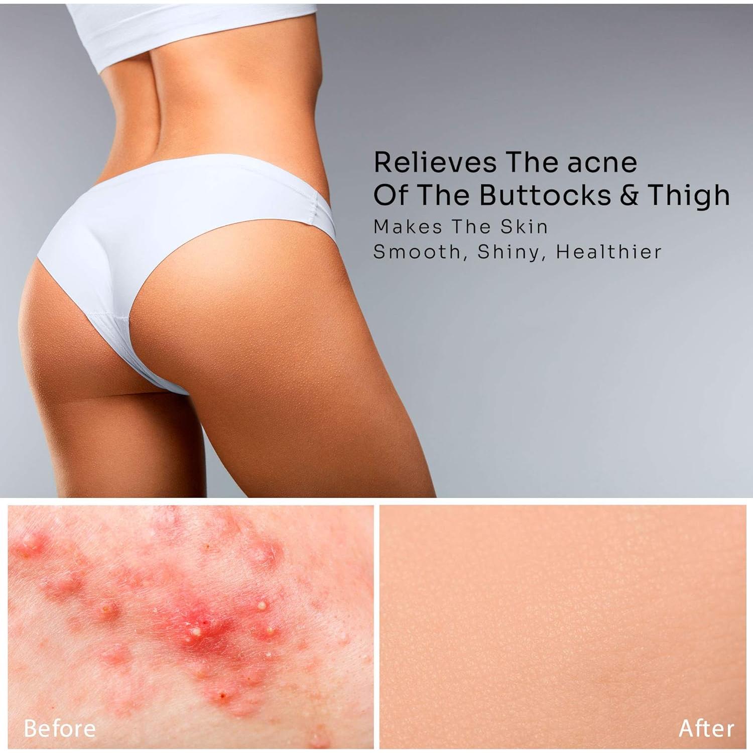 Crema Antiacné BellamiLuxx 100g con 2% Ácido Salicílico