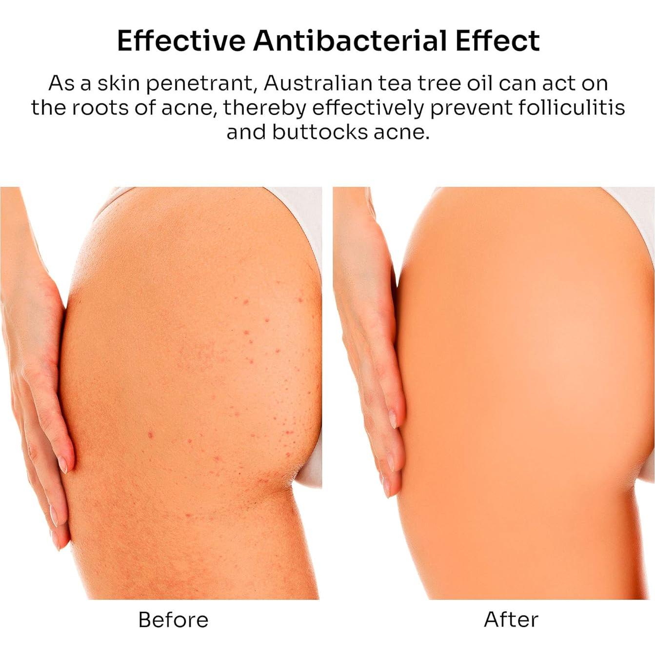 Crema Antiacné BellamiLuxx 100g con 2% Ácido Salicílico