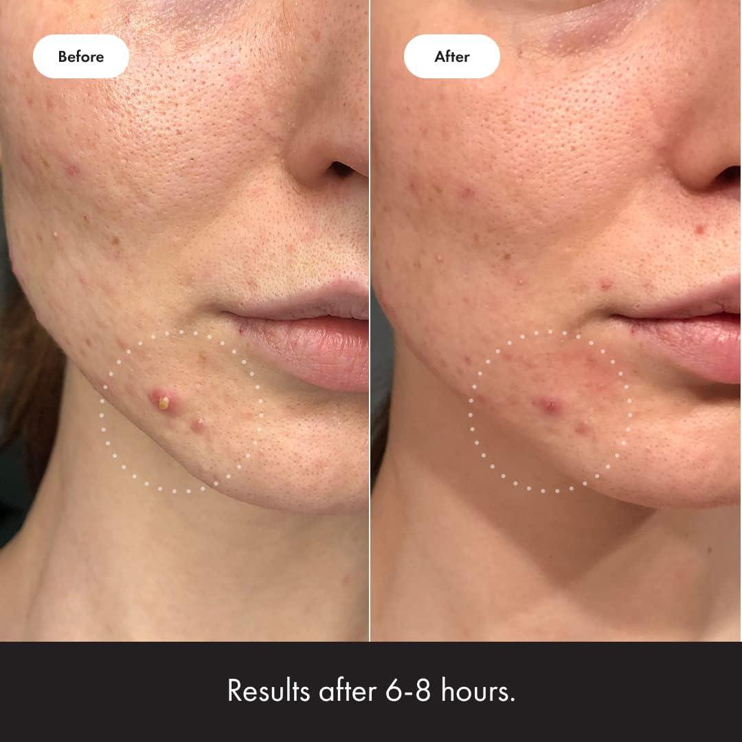 Mighty Patch Invisible+ Parche Hidrocoloide para Acné 39 Piezas