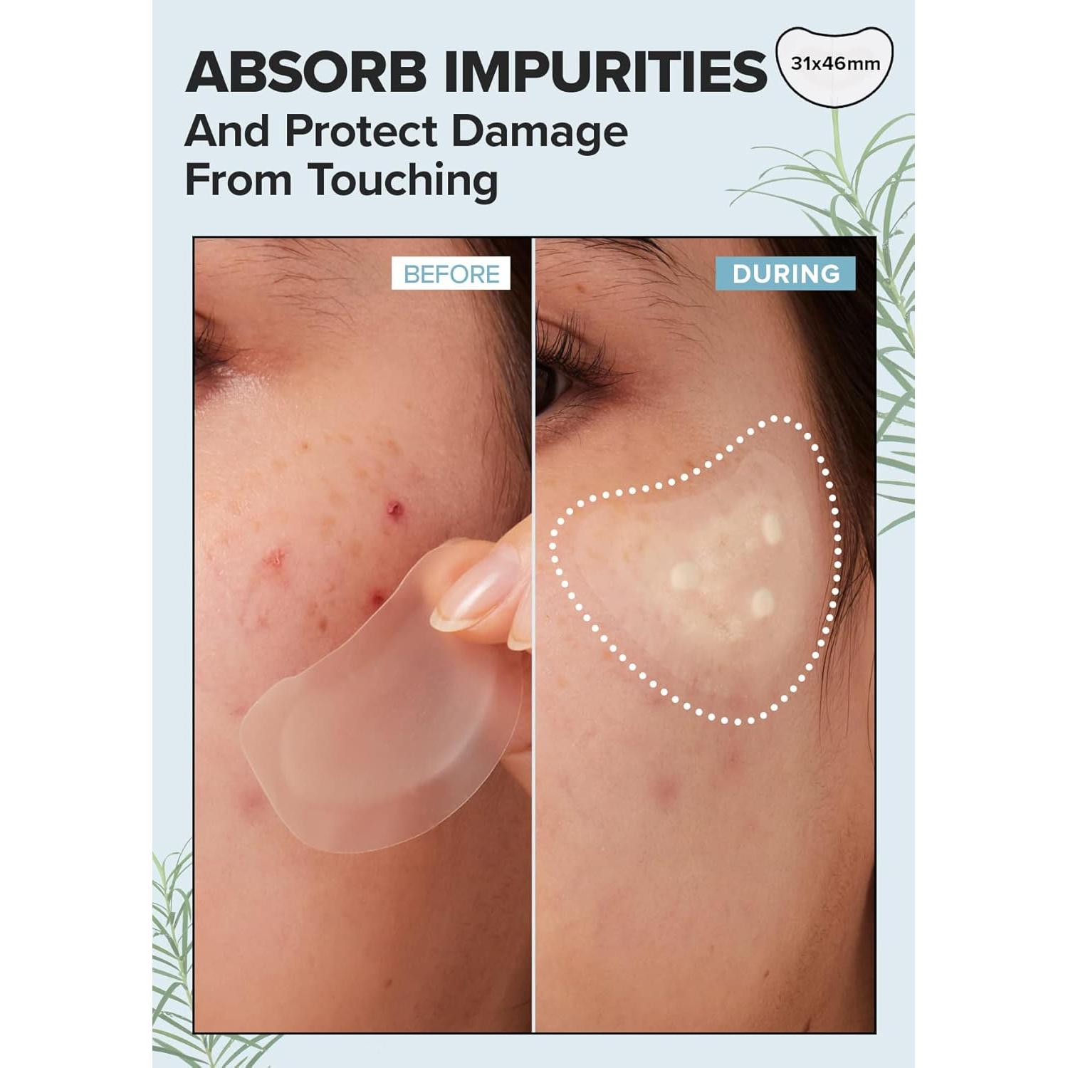 I DEW CARE Parche Hidrocoloide Acné 9 Unidades Barbilla