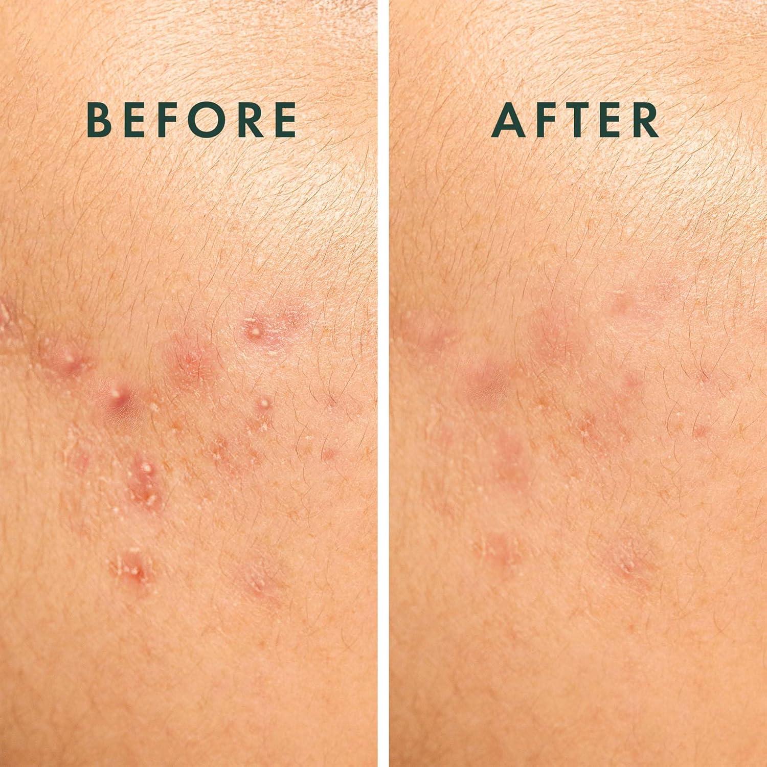 Parche para Granos Rael 20 Unidades Hidrocoloide Vegano