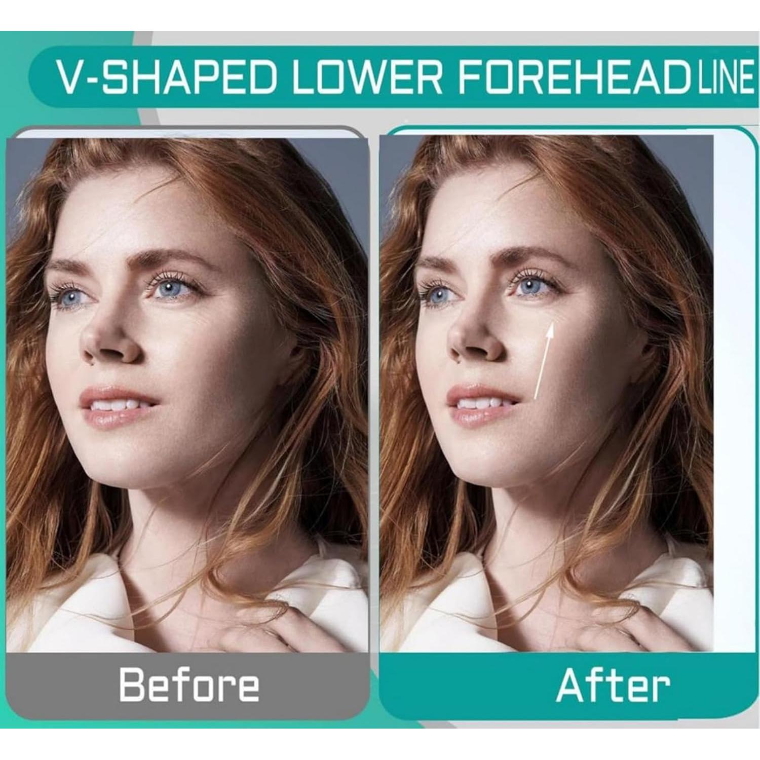 Ejercitador de Mandíbula Sushenwe 6 Pcs Silicona 3 Niveles