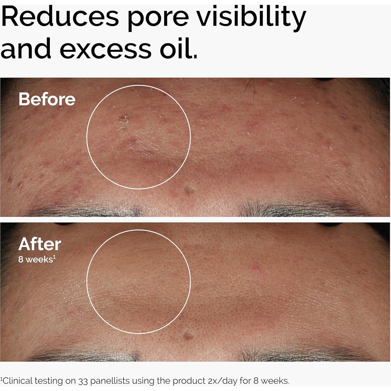 Suero Niacinamida 10% + Zinc 1% El Ordinario 60 ml