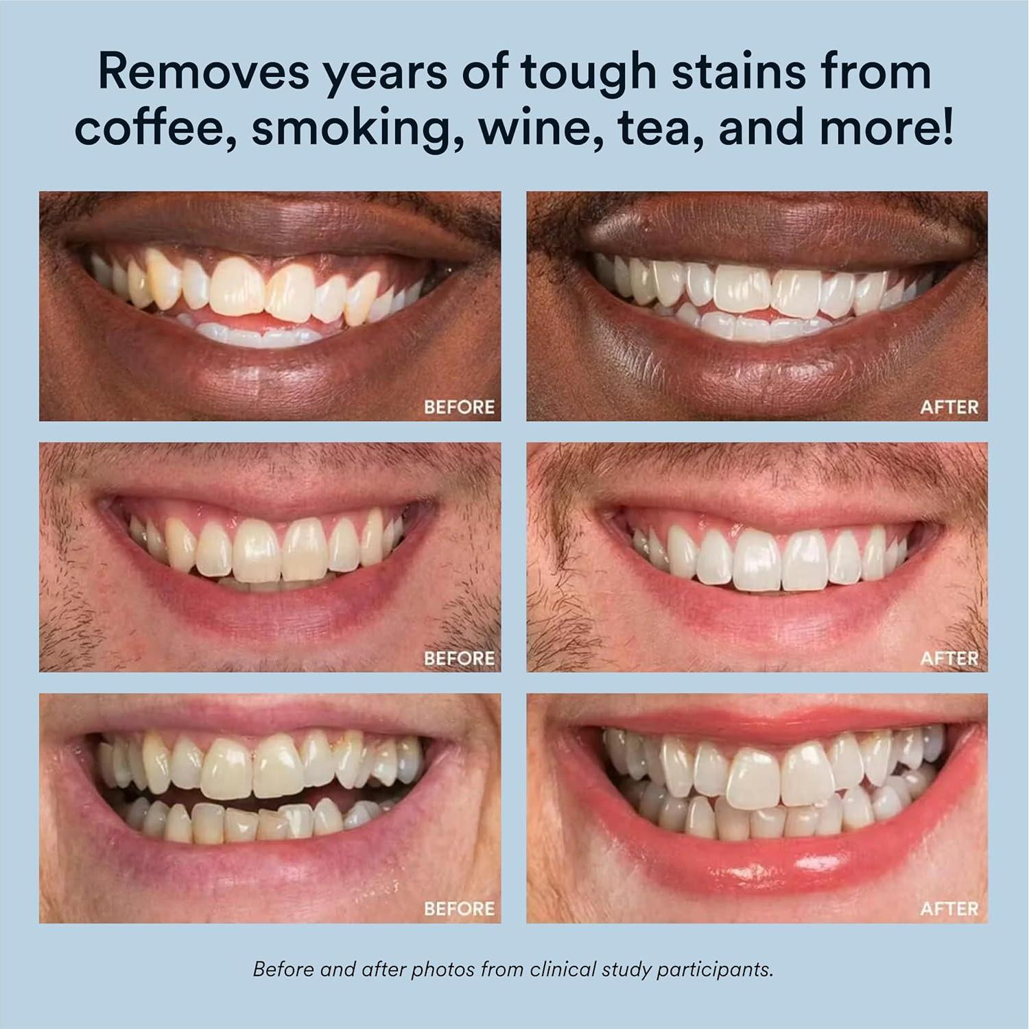 Kit de Blanqueamiento Dental Auraglow LED 35% Carbamida 20 Tratamientos