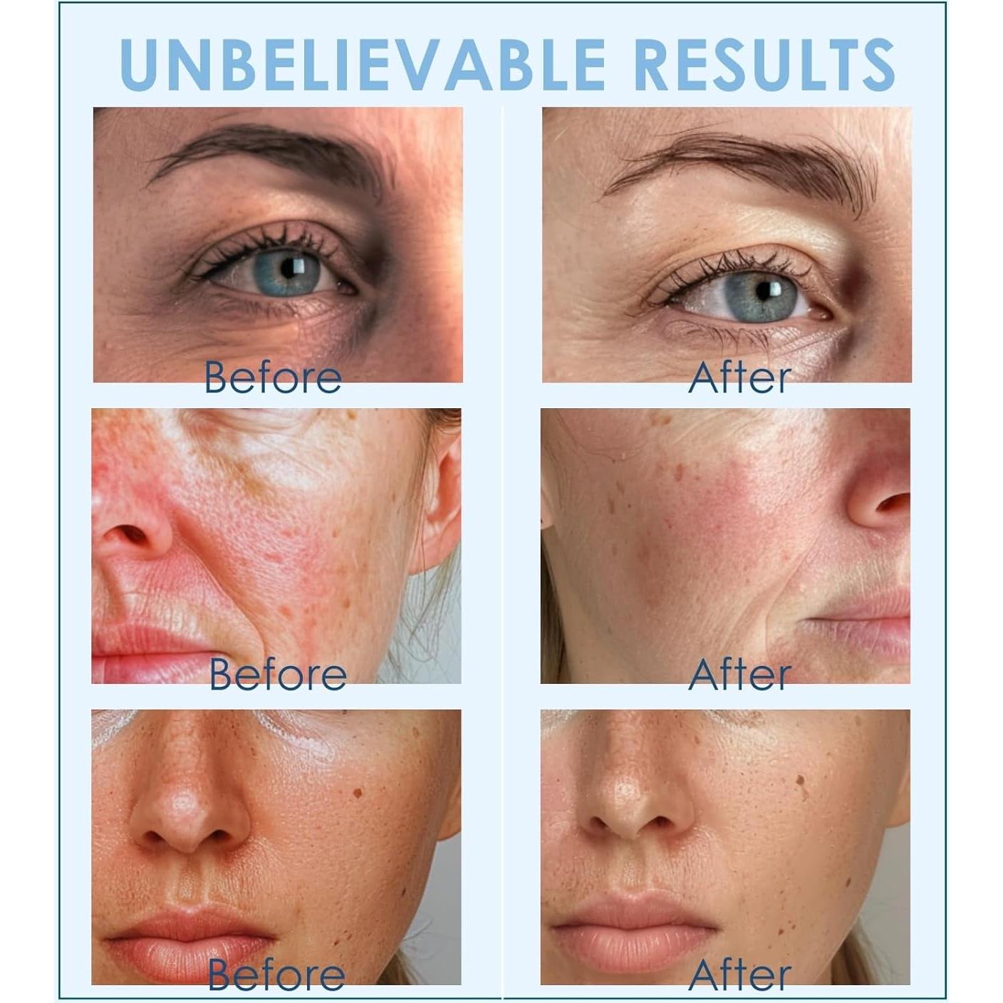 Bolas de Hielo Faciales Lazzybeauty, Masajeador Criogénico 14cm