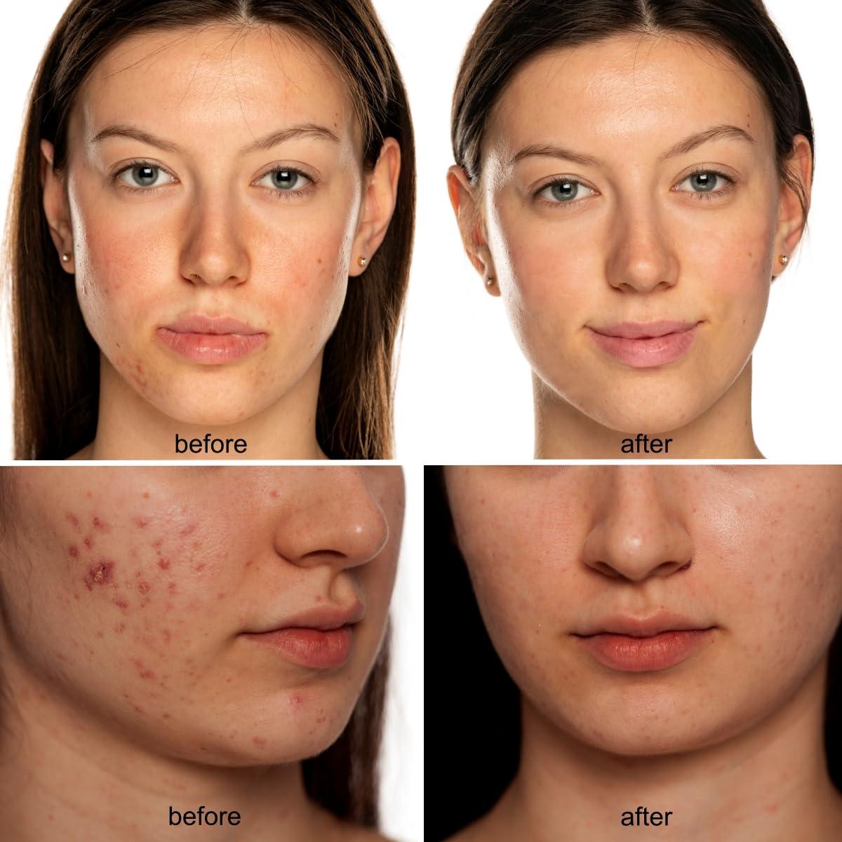 Máscara LED de Belleza AROZA KFB265 - Terapia Luz Roja y Azul