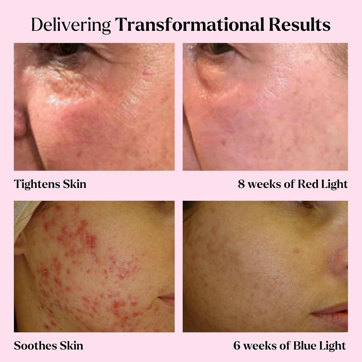 Kit Spa Terapia Luz LED VOGUENOW 4 Piezas Rejuvenecimiento