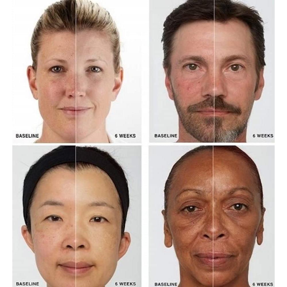 Máscara de Terapia de Luz Roja iDerma para Rejuvenecimiento Facial