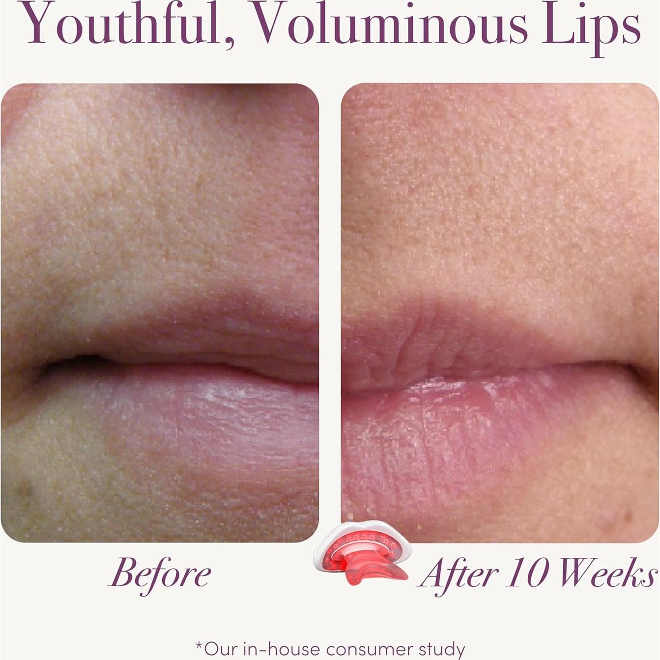 Dispositivo de Terapia de Luz Roja reVive Lux para Labios