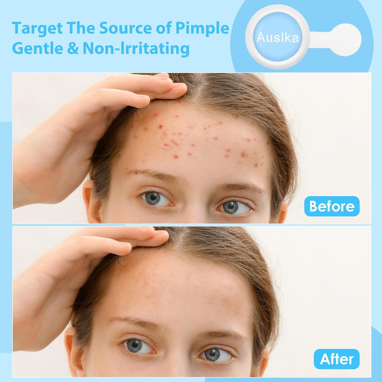 Parche para Granos LED Rojo y Azul AUSLKA - 6 Piezas