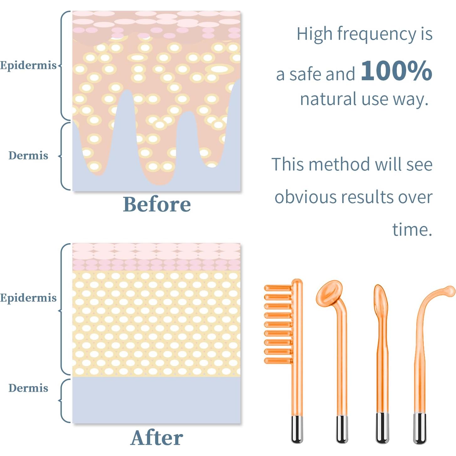 Máquina Facial de Alta Frecuencia TUMAKOU Portátil 4 Tubos