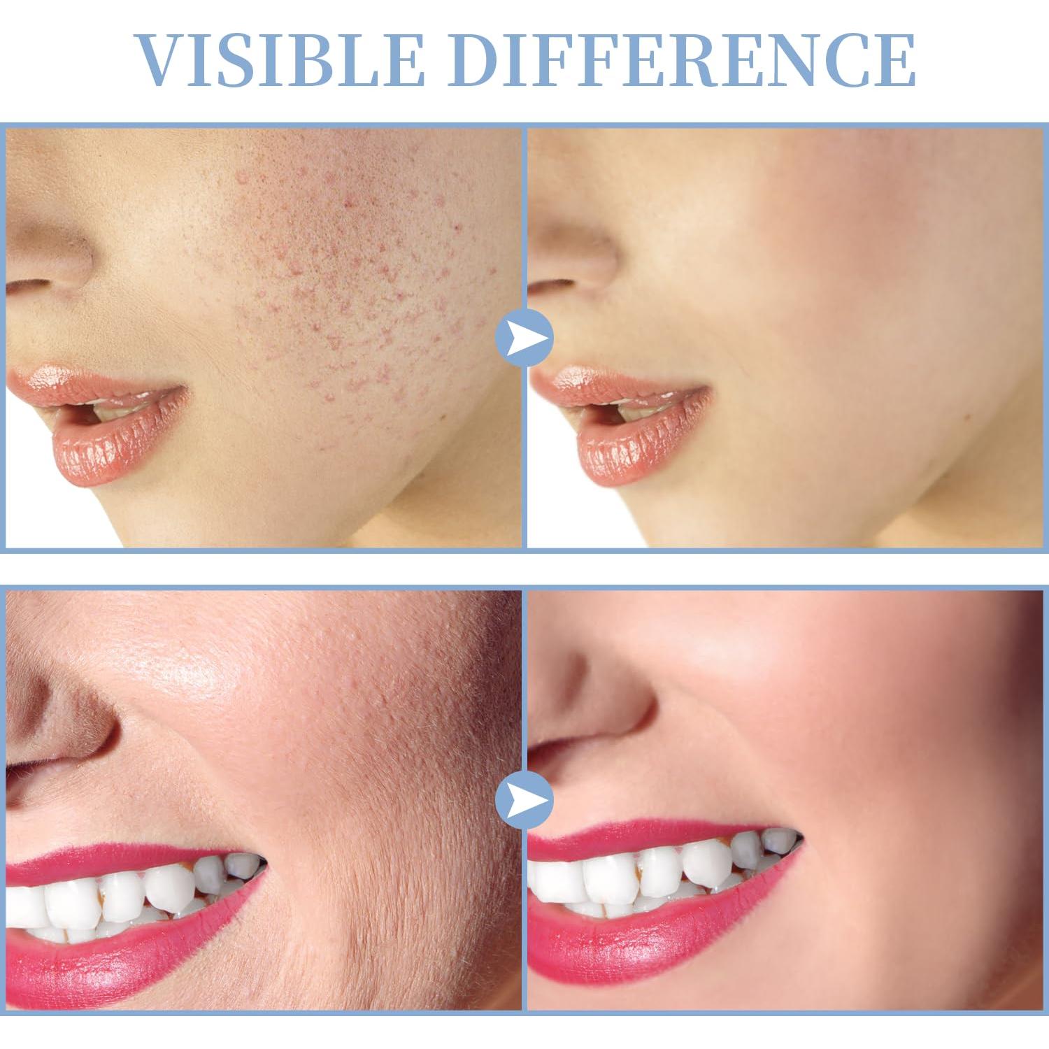 Máquina Facial de Alta Frecuencia TUMAKOU Portátil 4 Tubos