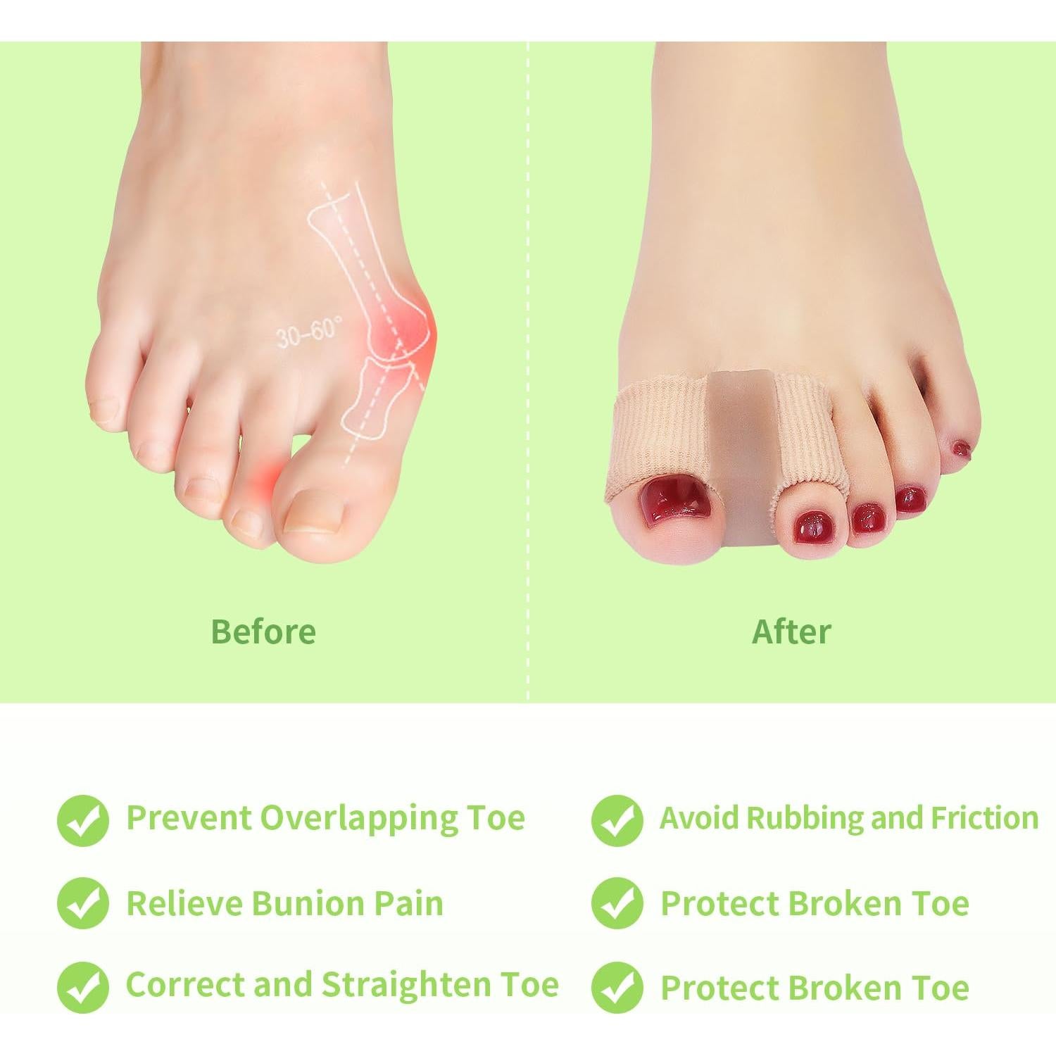 Separadores de Dedos de Bunion Niupiour - Gel Transpirable para Alivio del Dolor