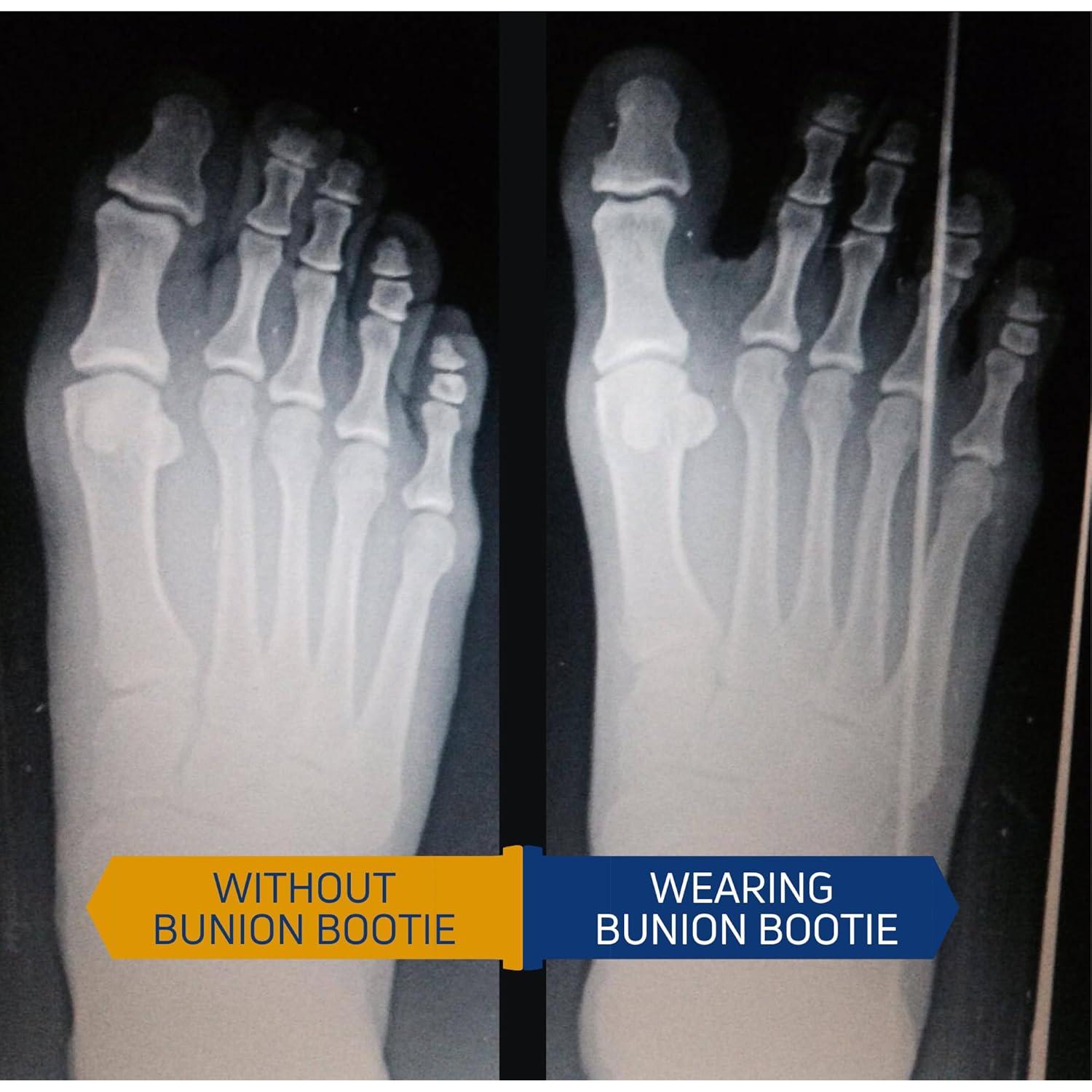 Corrector de Juanetes Bunion Bootie Unisex Pie Izquierdo