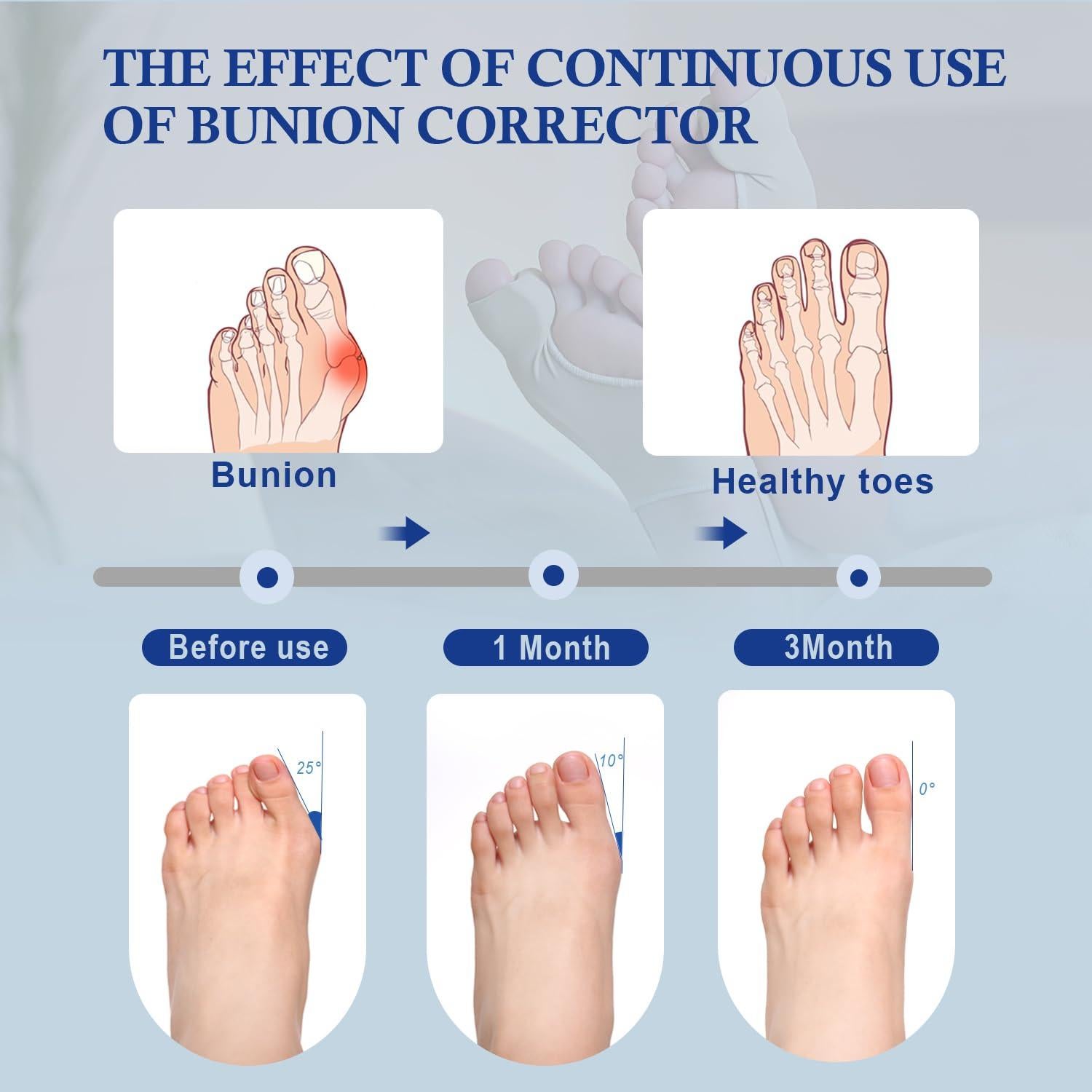Corrector de Juanetes ELFON para Mujeres - Alivio Hallux Valgus