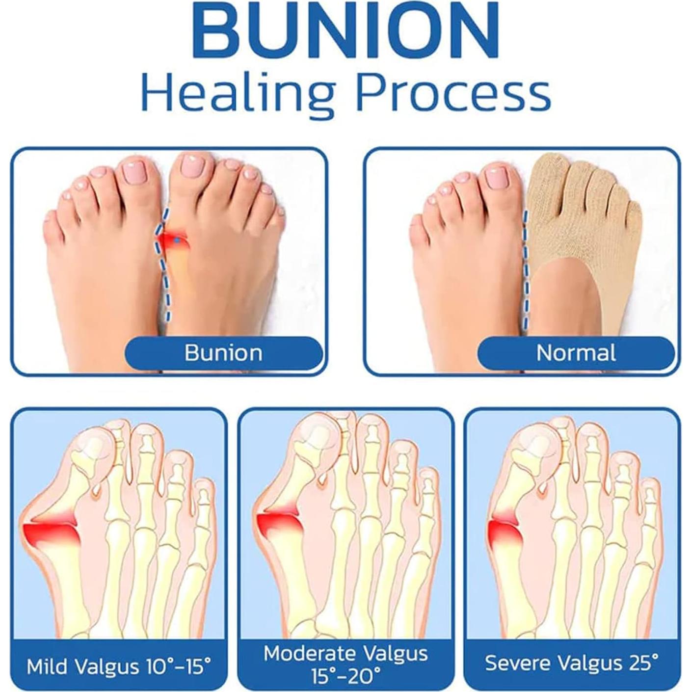 5 Pares de Calcetines Alineadores de Dedos Projoint para Juanetes