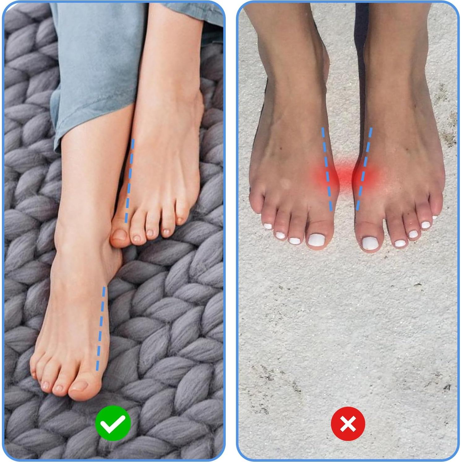 Corrector de Juanetes PEOVLVN 2 Pcs Dedo Grande Alivio