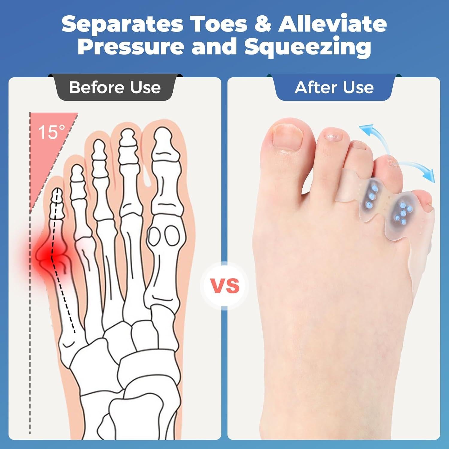 Kit Corrector de Juanete Tevezo con Separadores de Dedo