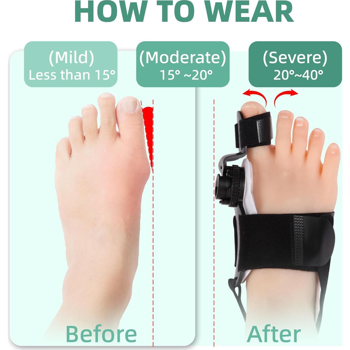 Corrector de Juanetes Ajustable FMGJKQL para Hombres y Mujeres