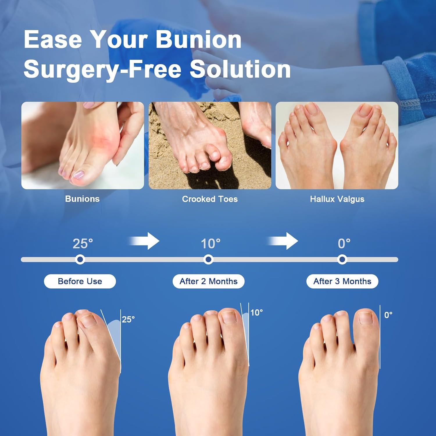 Corrector de Juanetes Pomreck con Almohadilla de Gel - 2 Piezas