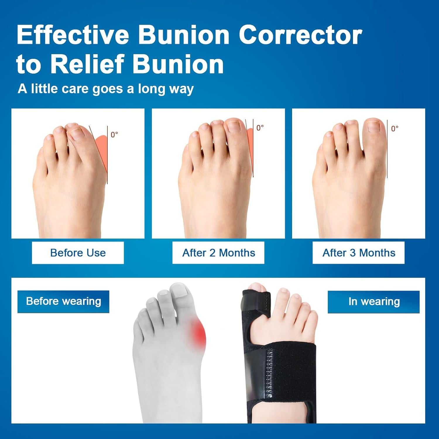 Corrector de Juanetes Pomreck con Almohadilla de Gel - 2 Piezas