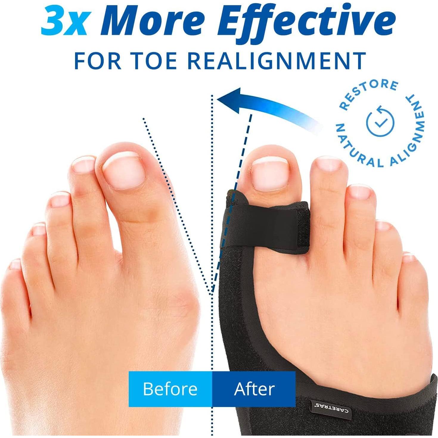 Corrector de Juanetes Wifamy Unisex - Férula y Separadores