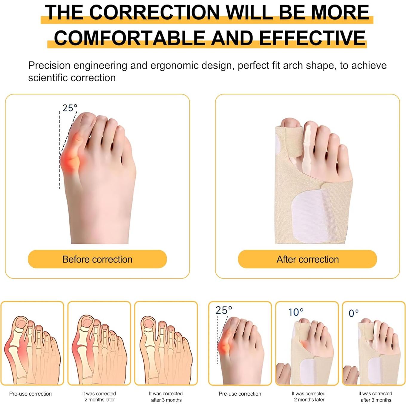 Corrector de Juanetes Siwujia Ortopédico Ajustable 2 Piezas