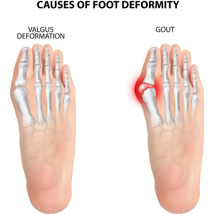Corrector de Juanetes Qxotvzy Beige para Alivio del Dolor