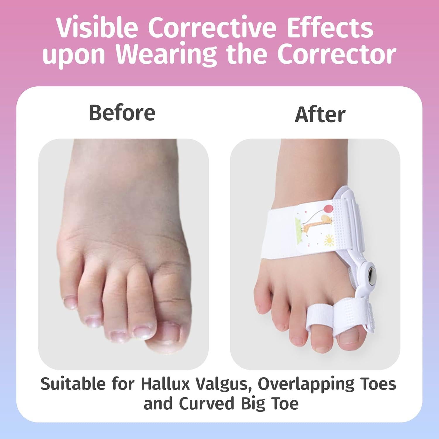 Corrector de Juanetes para Niños CONSYSI - Férula Ajustable