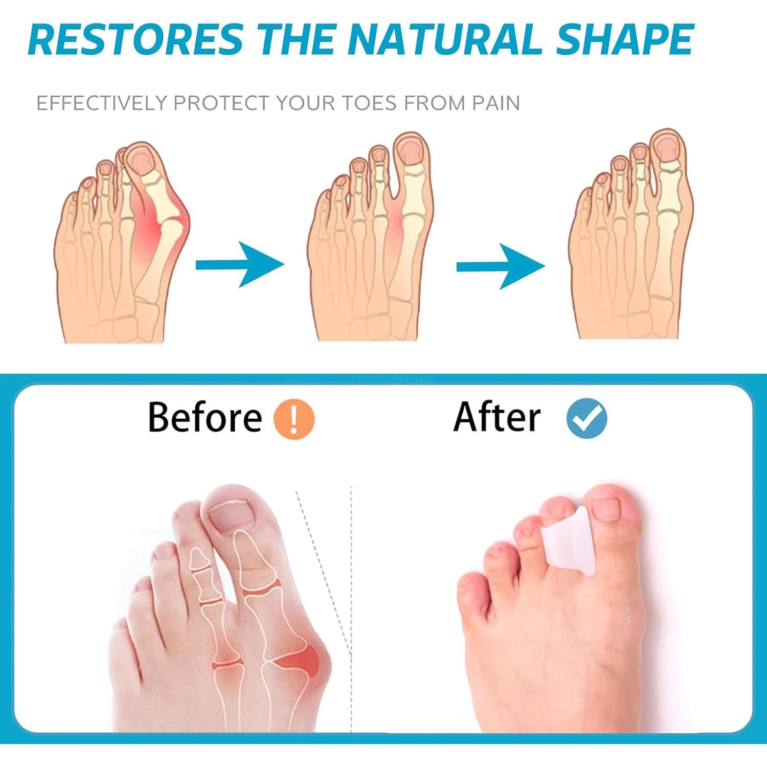 Corrector de Dedo en Martillo Nolimvita - Paquete de 6 Pequeño