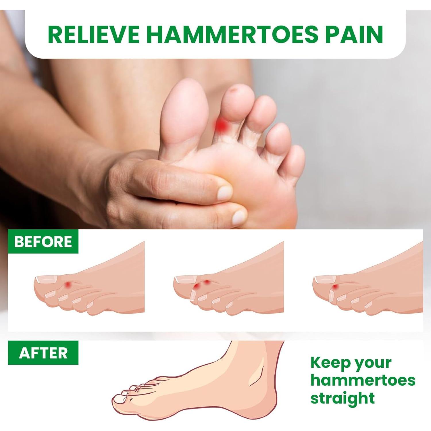 Corrector de Dedo en Martillo Bukihome - 6 Enderezadores Medianos