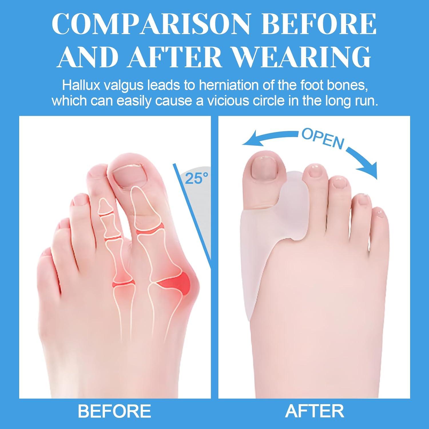 Paquete de 6 Protectores de Gel para Juanetes Nailgelicer