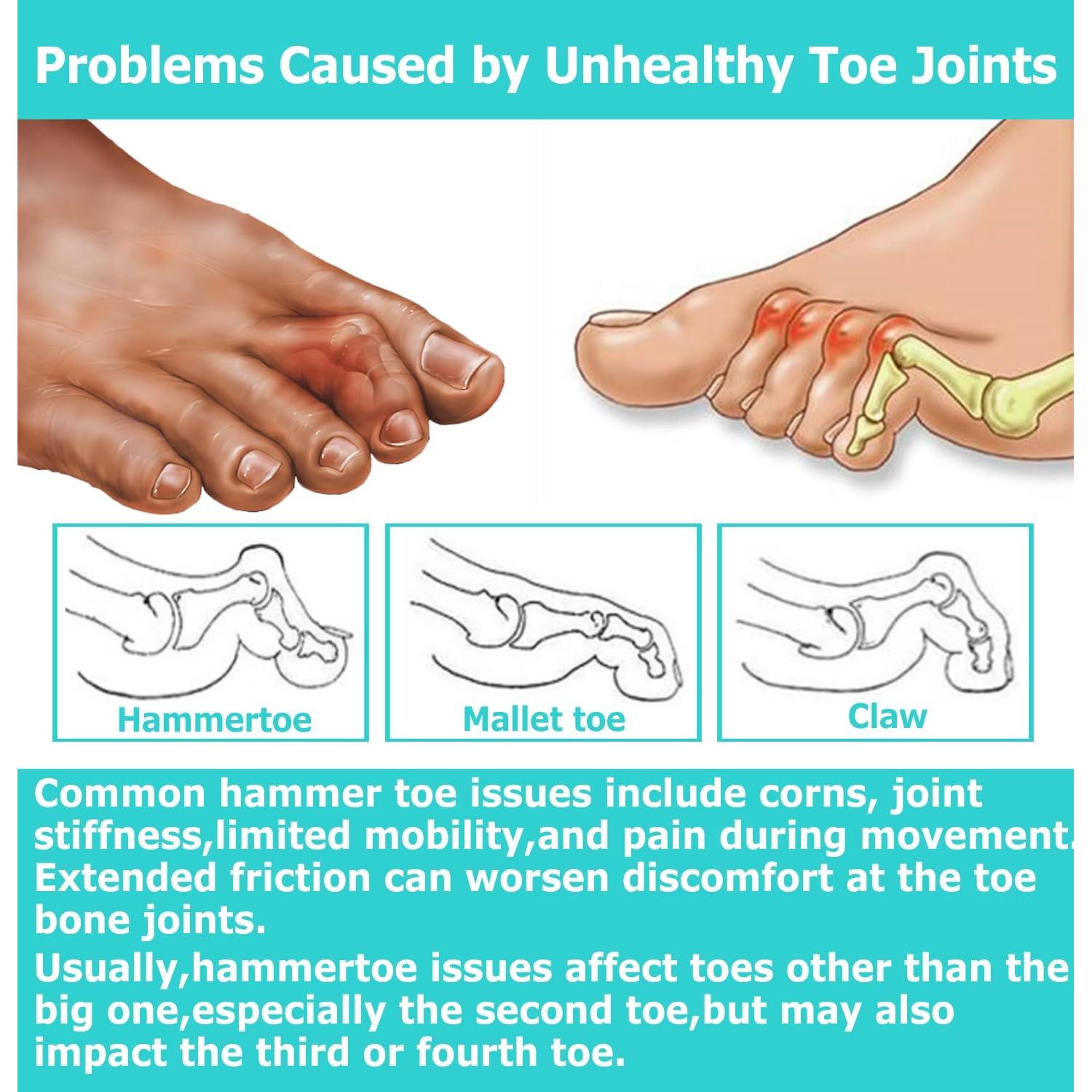 Corrector de Dedo en Garra Byehambuni, 6 Piezas Pequeñas Beige