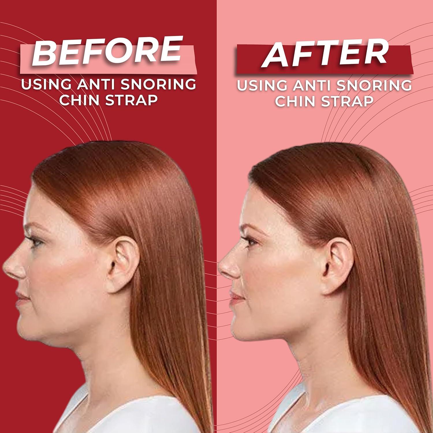 Correa para Barbilla Antironquidos Massner Ajustable Transpirable