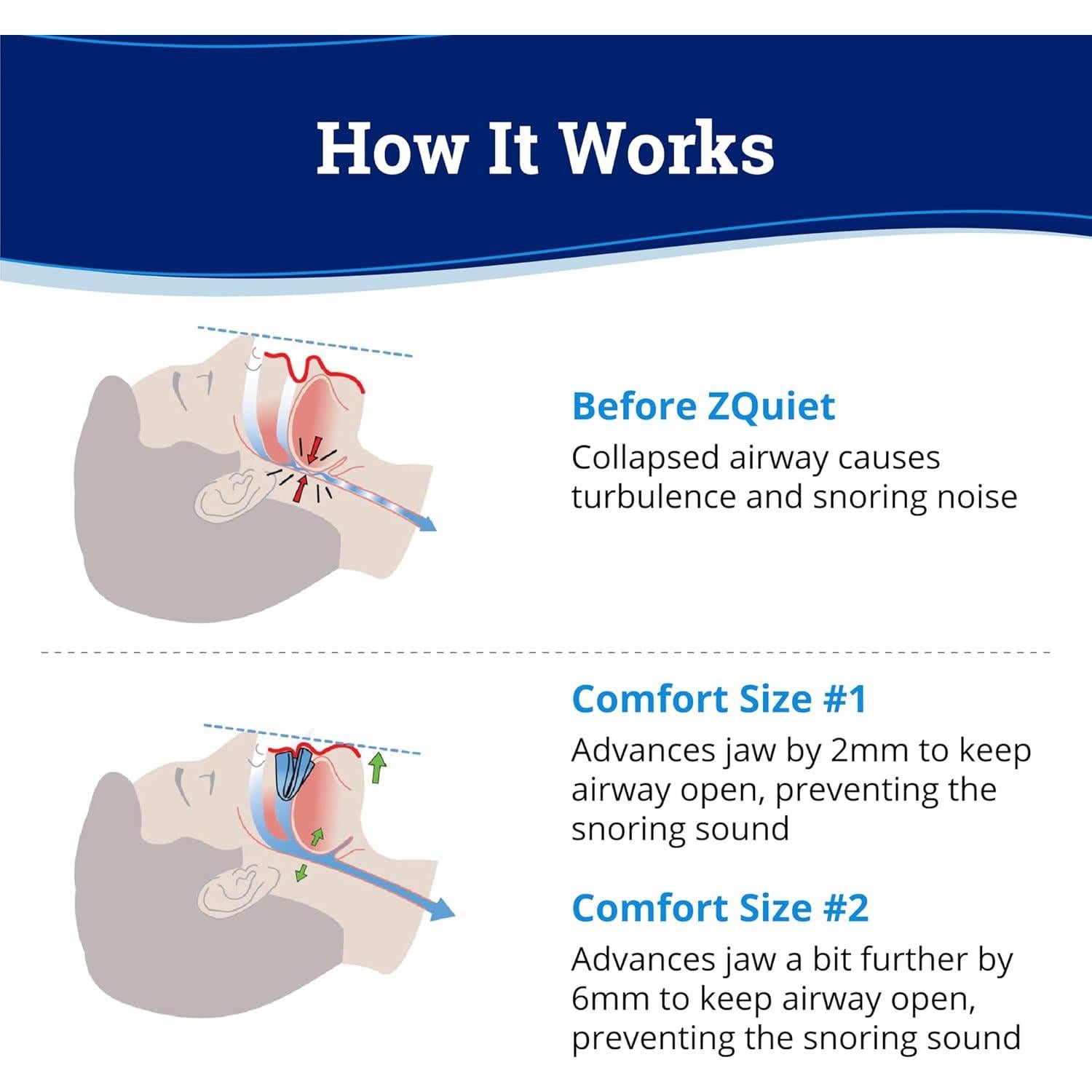 ZQuiet Kit Antisnore - 2 Boquillas + Dilatador Nasal