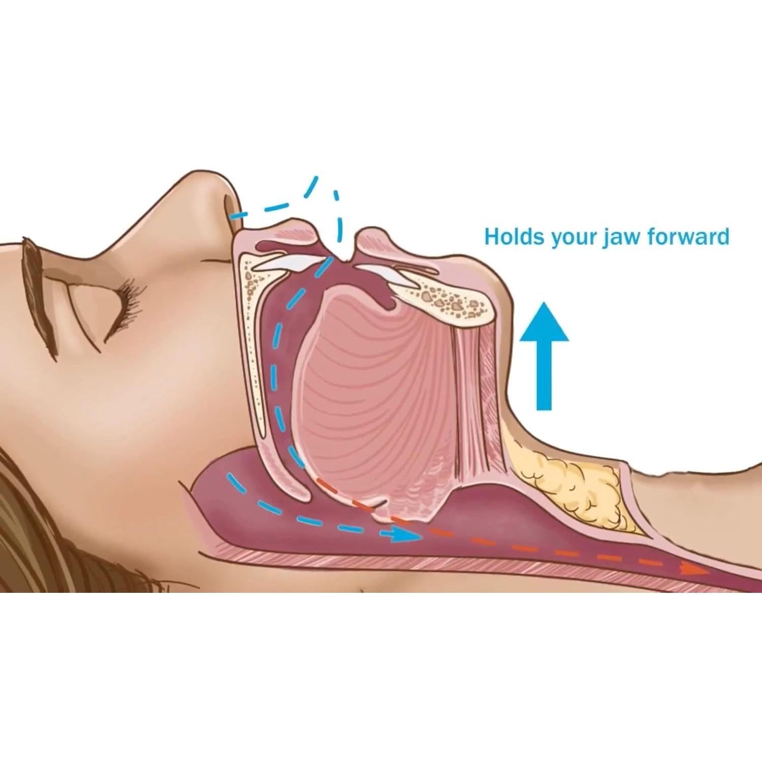 Protector Bucal Anti Ronquidos Dentemp SleepTight 2pk