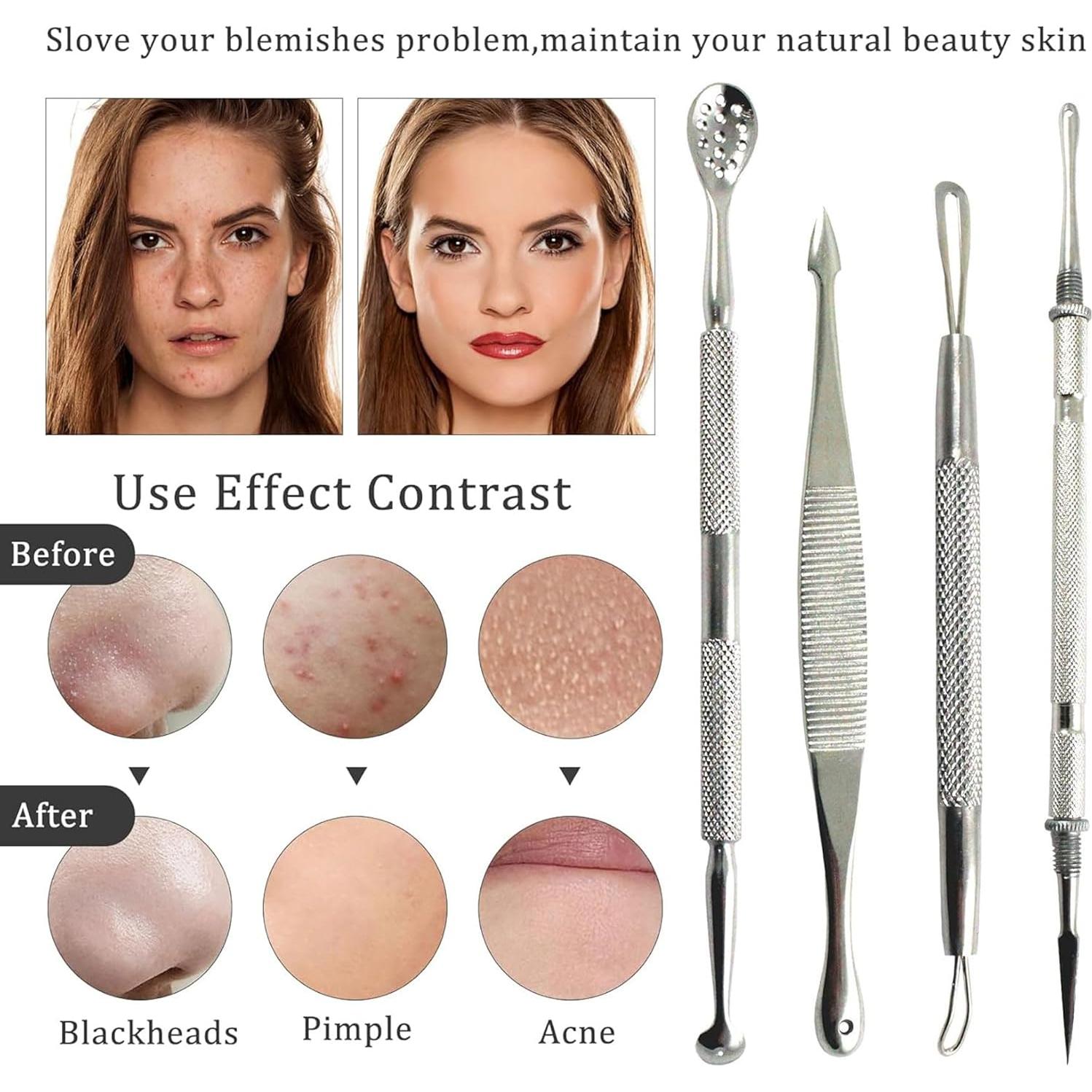 Kit de Extractores de Puntos Negros Krisp Beauty 4 Piezas